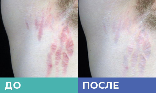 до и после применения Дерма Соф